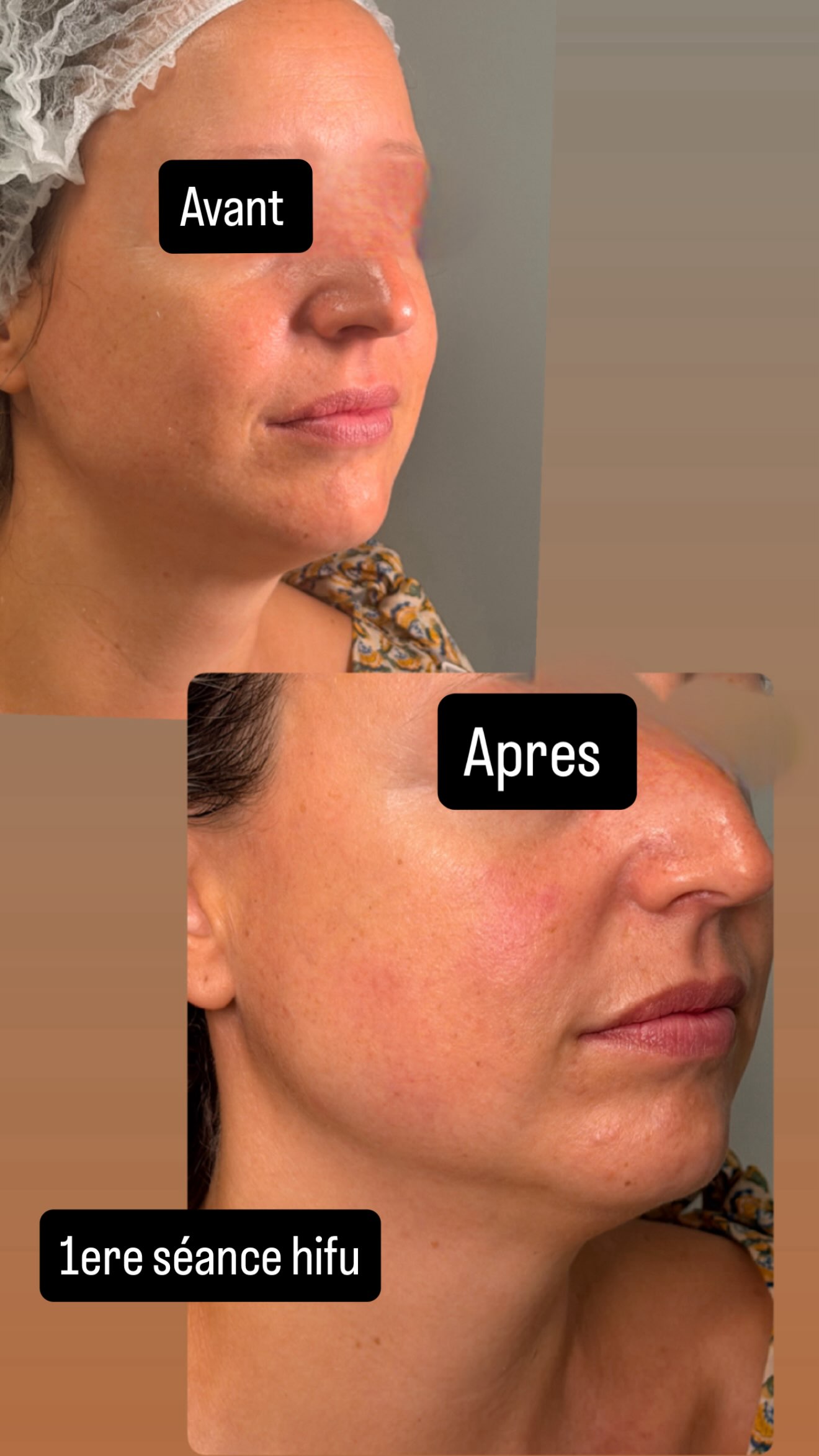 Résultats réels Avant / Après HIFU ovale du visage et ligne mandibulaire à Étampes - Dikki Beauté