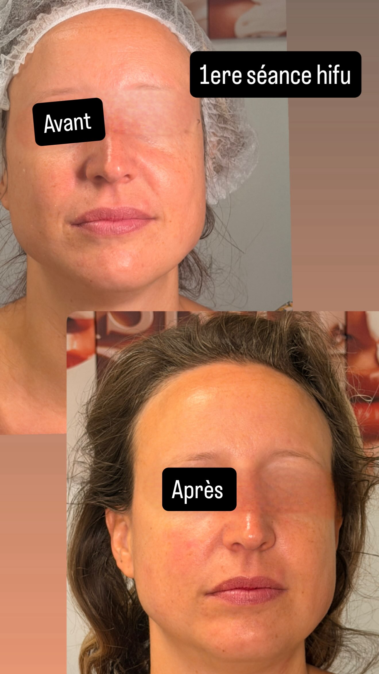 Résultats Avant Après HIFU visage entier femme - Dikki Beauté